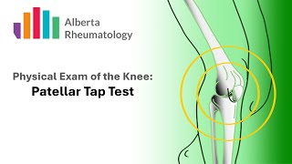 Rheumatology KNEE exam Patellar Tap Test [upl. by Yrok]