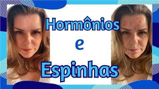 Acne hormonal e outros tipos de acne [upl. by Noyerb]