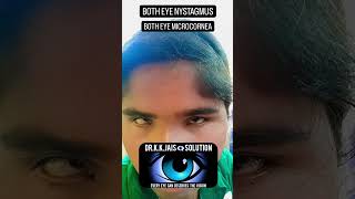 CONGENITAL NYSTAGMUS amp MICROCORNEA IN BOTH EYE ophthalmology eyes draakanshashomeopathy [upl. by Yrahcaz]