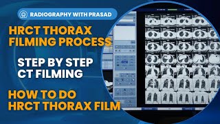 How To Do HRCT Thorax Filming in GE  HRCT Thorax Filming  Mediastinum Window and Lung Window [upl. by Ennairb]