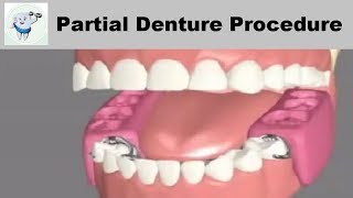 Removable Partial Dentures Steps [upl. by Enaols]