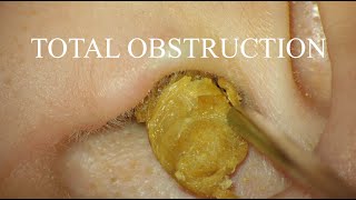 TOTAL OBSTRUCTION  EAR WAX REMOVAL  4KHD [upl. by Gelb291]