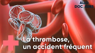 Thrombose  toutes vos questions  Allo Docteurs [upl. by Airdnaxila]