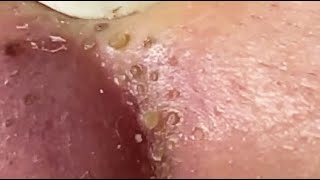 TOP OF BLACKHEADS REMOVAL FROM THE NOSE 😨 relaxing blackheads [upl. by Hadeehsar]