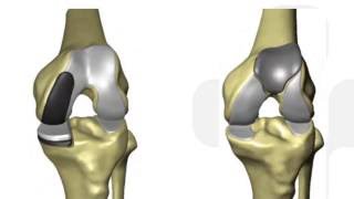 Outcomes amp Benefits of Robotic Joint Replacement Surgery with Dr Charles Rutherford [upl. by Ytinav]