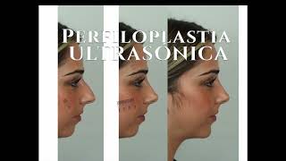 Explicando la PERFILOPLASTIA ULTRASONICA Rinoplastia Ultrasónica  Mentoplastia Ultrasónica [upl. by Notwen]