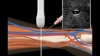 Anlage invasive arterielle Druckmessung [upl. by Nolyag157]