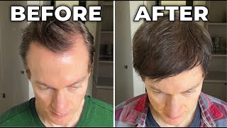 How I Reversed My Hair Loss  Greying [upl. by Ardnossak]