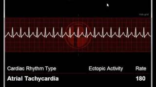 ECG Simulator by Pace Symposia Demonstration ecgsimulatornet [upl. by Alletniuq970]