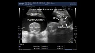 Anencephaly with Polyhydramnios in pregnancy of about 26 weeks [upl. by Malek]