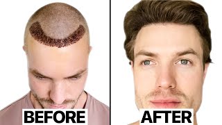 My Hair Transplant Results 6 Months  Surgeon Reacts [upl. by Nilats]