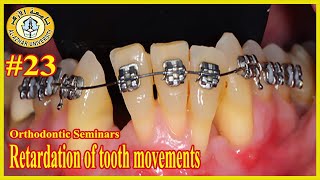 23 Retardation of tooth movements سيمينارات تقويم الأسنان جامعة الأزهر [upl. by Ahsiekam586]