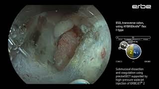 ESD of a LSTNG tumor at the splenic flexure using HYBRIDknife® flex IType [upl. by Ursola]