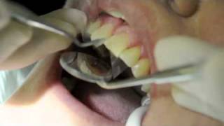 Teeth Bonding  Teeth Bonding Procedure [upl. by Aikemahs]