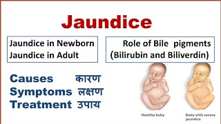 Jaundice  Causes Symptoms Treatment  पीलिया [upl. by Novia210]