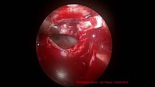 Endoscopic craniopharyngioma surgery [upl. by Elocal530]