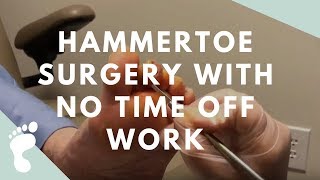 Hammertoe Surgery With No Time Off Work [upl. by Esdnyl]