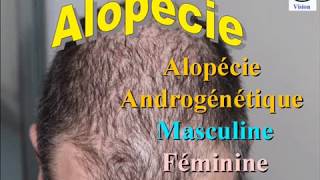 Chute de Cheveux  Alopécie androgenique chez lHomme et chez la Femme [upl. by Swithbert930]