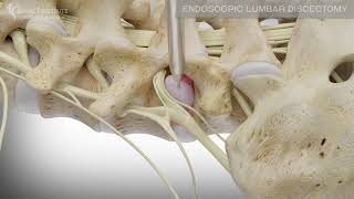 Endoscopic Lumbar Discectomy  Spine Institute of North America [upl. by Idnim]