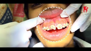 Gingivectomy in an Orthodontic Patient with swollen gums Part2 [upl. by Ali]