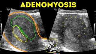 Adenomyosis  Ultrasound  Case 42 [upl. by Talie]