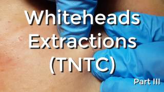 Whiteheads Extraction TNTC  Session I  Part 3 of 3 [upl. by Yelyk]