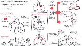 Is Stage 4 Lung Cancer Curable [upl. by Corkhill]