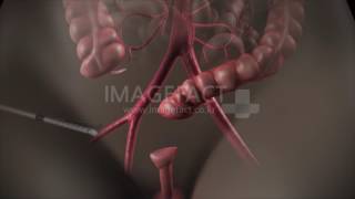 소장 소장절제 로봇수술  small intestine ectomy [upl. by Horbal]