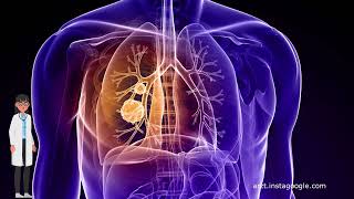 Die Rolle der Bestrahlung bei der Behandlung von Lungenkrebs [upl. by Pickford]