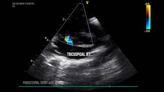 PERSISTENT PULMONARY HYPERTENSION IN THE NEONATE [upl. by Allecram]