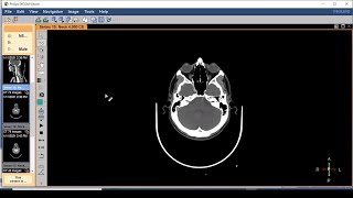 DICOM viewer software the easiest way to review CTs and MRIs on your PC [upl. by Cindelyn]