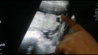 Placenta Previa  Major Posterior Placenta Previa [upl. by Ollayos]