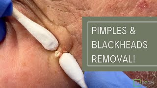 Pimples and Blackheads Removal  Dr Derm [upl. by Haidabez777]