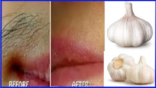 Unwanted hair removal for women naturally with garlic remedy  face hair removal for women at home [upl. by Nomla]