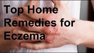 Top Home Remedies for Eczema [upl. by Noraj169]