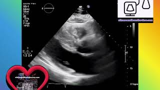 Asymmetric Hypertrophic Cardiomyopathy Echocardiography [upl. by Ikoek]