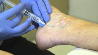 Spider Vein Treatment  Sclero Therapy [upl. by Wrdna734]