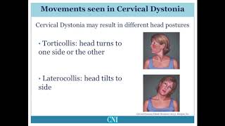 What is Cervical Dystonia [upl. by Petronella472]