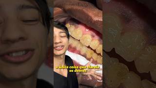 Assim é Feito o Clareamento Dental Profissional no Dentista shorts [upl. by Notyap329]