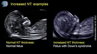 Nuchal translucency NT [upl. by Airdnaz]