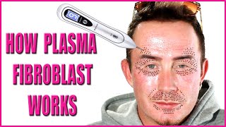 Plasma Fibroblast  How Fibroblast Plasma Works Beneath the Skin [upl. by Doi632]