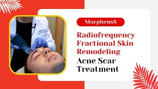 Morpheus8  Radiofrequency Fractional Skin Remodeling  Acne Scar Treatment  Jason Emer MD [upl. by Enail]