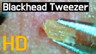 27 Pull out Blackheads  Whiteheads Close up 300X  Blackheads Removal [upl. by Ybroc247]