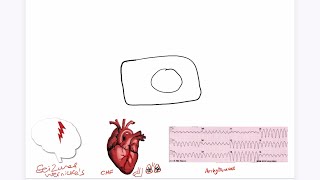 Refeeding Syndrome Explained USMLE [upl. by Kcorb]