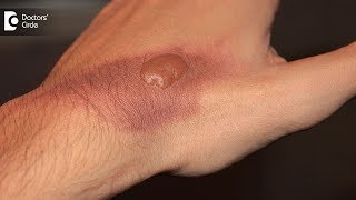 How to treat a burn blister at home Tips to avoid burn scar  Dr Pavan Murdeshwar [upl. by Cissie659]