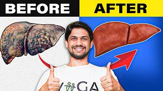 STOP Fatty Liver Disease Naturally  5 Daily Habits for Liver Health  Saurabh Bothra [upl. by Dalis]