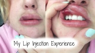 THE UGLY TRUTH ABOUT LIP INJECTIONS  My Experience [upl. by Ellak]