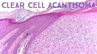 Clear Cell Acanthoma Dermpath in 5 Minutes pathology dermatology dermatopathology [upl. by Eilasor]