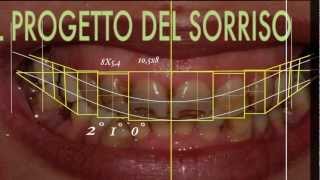 Cambiare laspetto del sorriso con faccette dentali  SMILE DESIGN [upl. by Thurstan]