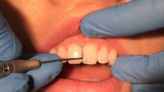 Periodontal Probing [upl. by Attiuqram604]